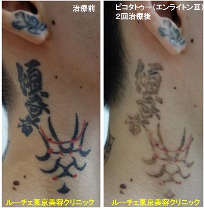 タトゥー除去ピコレーザー、首、2回、黒、赤