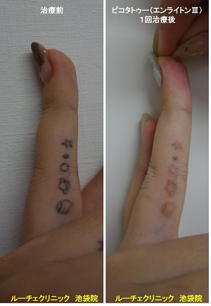 タトゥー除去ピコレーザー、指、１回、黒