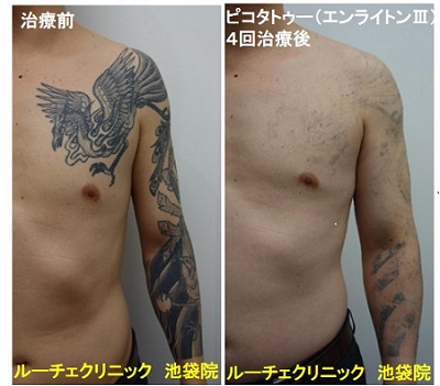 タトゥー除去ピコレーザー、胸~腕、4回、黒