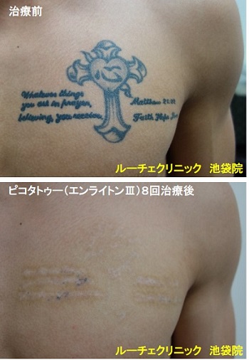タトゥー除去ピコレーザー、胸、8回、黒