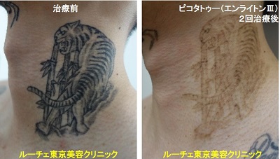 タトゥー除去ピコレーザー、腕、5回、黒
