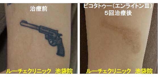タトゥー除去ピコレーザー、腕、5回、黒
