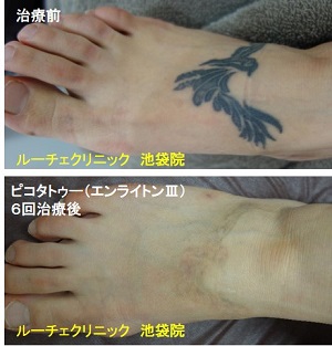タトゥー除去ピコレーザー、足、6回、黒