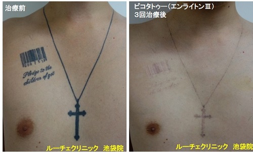タトゥー除去ピコレーザー、胸、3回、黒