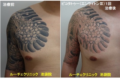 タトゥー除去ピコレーザー、腕~胸、１回、黒