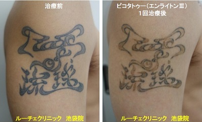 タトゥー除去ピコレーザー、腕、１回、黒