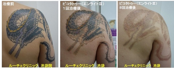 タトゥー除去ピコレーザー、腕~背中、8回、黒、紫、黄色