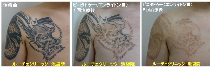 タトゥー除去ピコレーザー、腕~胸、8回、黒