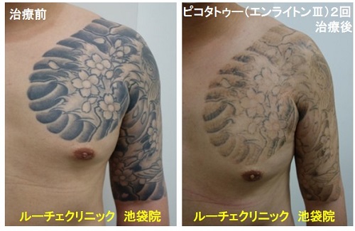 タトゥー除去ピコレーザー、腕~胸、2回、黒