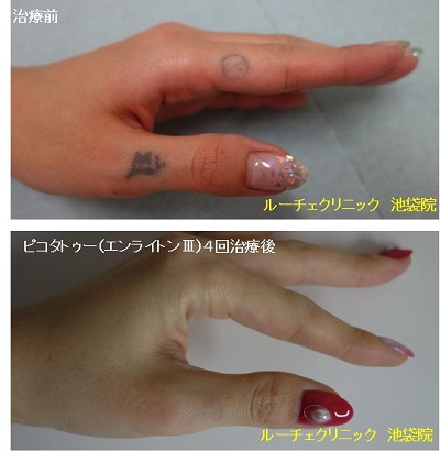 タトゥー除去ピコレーザー、指、4回、黒