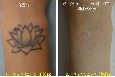 タトゥー除去ピコレーザー、手首、８回、黒、水色