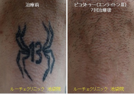 タトゥー除去ピコレーザー、首、7回、黒