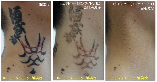 タトゥー除去ピコレーザー、首、6回、黒、赤