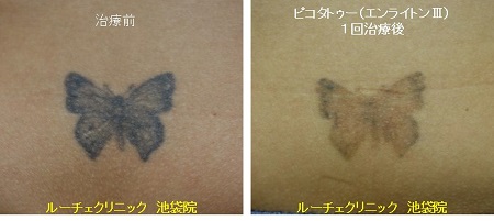 タトゥー除去ピコレーザー、腰、１回、黒
