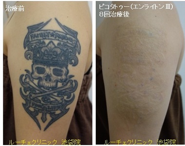 タトゥー除去ピコレーザー、腕、８回、黒