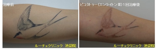 タトゥー除去ピコレーザー、腕、１回、黒