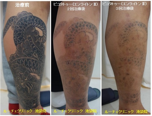 タトゥー除去ピコレーザー、足、3回、黒