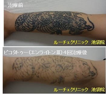 タトゥー除去ピコレーザー、腕、4回、黒