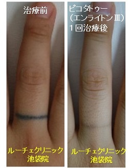 タトゥー除去ピコレーザー、指、1回、黒