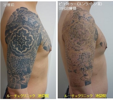 タトゥー除去ピコレーザー、腕から胸、3回、黒