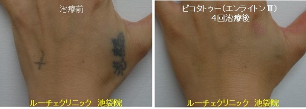 タトゥー除去ピコレーザー、手の甲、4回、黒