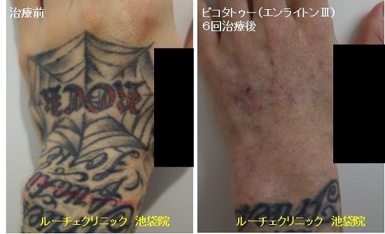 タトゥー除去ピコレーザー、手の甲、6回、黒