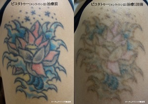 タトゥー除去ピコレーザー、１回、腕、黒、ピンク、青色、水色