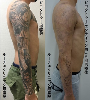 タトゥー除去ピコレーザー、１回、腕、黒