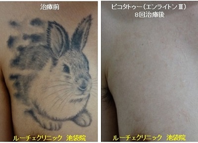 タトゥー除去ピコレーザー、8回、胸、黒