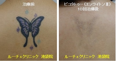 タトゥー除去ピコレーザー、10回、背中、黒、紫、水色