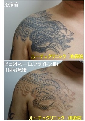 タトゥー除去ピコレーザー、1回、胸、黒