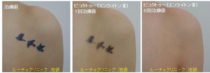 タトゥー除去ピコレーザー、6回、胸、黒