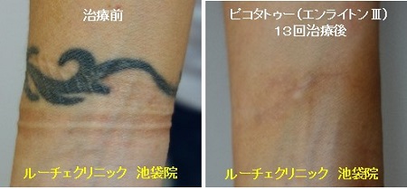 タトゥー除去ピコレーザー、13回、手首、黒