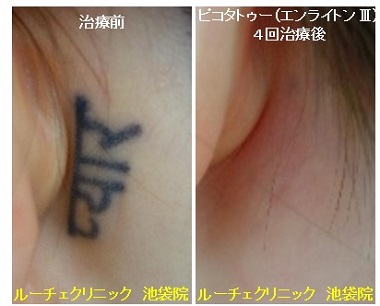 タトゥー除去ピコレーザー、4回、耳裏、黒