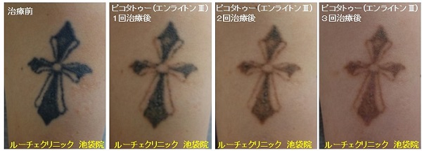 タトゥー除去ピコレーザー、3回、腕、黒