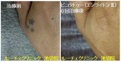 タトゥー除去ピコレーザー、6回、手の甲、黒