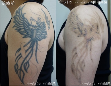 タトゥー除去ピコレーザー、4回、腕、黒