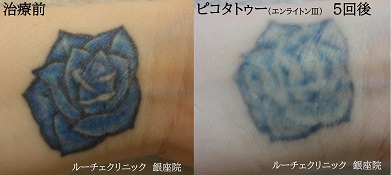 タトゥー除去ピコレーザー、5回、手首、水色、黒
