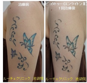 タトゥー除去ピコレーザー、1回、腕、黒、水色