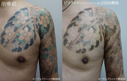 タトゥー除去ピコレーザー、胸から腕、２回、黒、オレンジ、緑