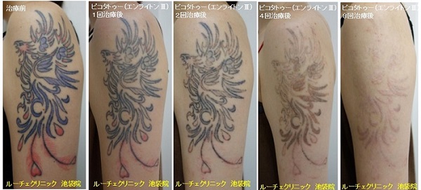 タトゥー除去ピコレーザー、8回、腕、黒、赤、紫