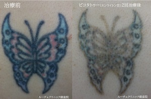 タトゥー除去ピコレーザー、2回、腕、黒、水色、ピンク