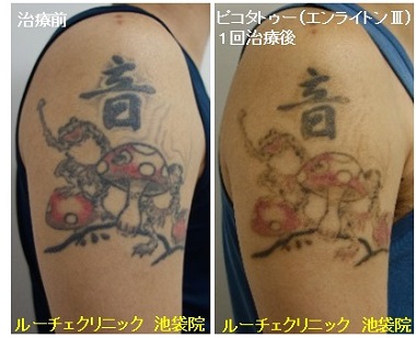 タトゥー除去ピコレーザー、1回、腕、黒、赤