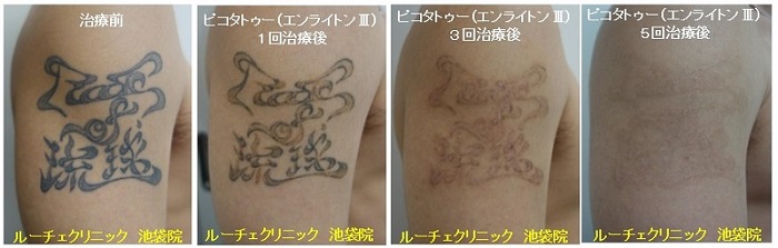 タトゥー除去ピコレーザー、5回、腕、黒