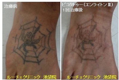 タトゥー除去ピコレーザー、1回、足の甲、黒