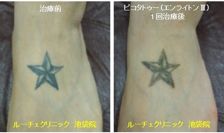 タトゥー除去ピコレーザー、1回、足、黒