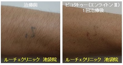 タトゥー除去ピコレーザー、1回、腕、黒