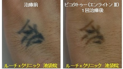 タトゥー除去ピコレーザー、1回、手、黒