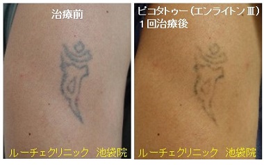 タトゥー除去ピコレーザー、1回、腕、黒