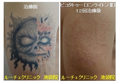 タトゥー除去ピコレーザー、12回、腕、黒、赤